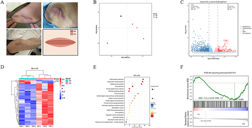 Figure 2 Gene expression profiles of human HS and NC differential genes and related signaling pathways. (A) Clinical scar samples and sampling schematic diagram. (B) Composition analysis of two sets of samples. (C) Volcanic maps show genes that express differences. (D) Differential gene clustering heat map is shown, and compared to non-hypertrophic scars, there are 25 genes upregulated and 288 genes downregulated in the skin hypertrophic scar. (E) KEGG enrichment analysis of differentially expressed genes in HS. (F) It was found that the P13K-Akt signaling pathway promotes inflammation and endothelial cell proliferation, while also inhibiting the formation of HS.