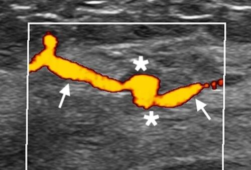 Figure 4 Power Doppler revealed that the aneurysm (asterisk) and its tract (arrow) completely filled with blood flow.