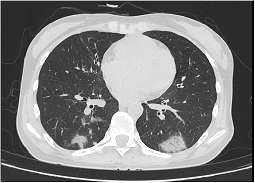 Figure 1 CT scanning revealed substantial pulmonary lesions.