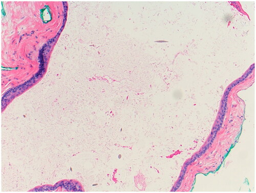 Figure 2. Histology of Eruptive Vellus Hair Cyst Cyst within the dermis with numerous vellus hair cysts in the lumen (Hematoxylin & Eosin, 100x).