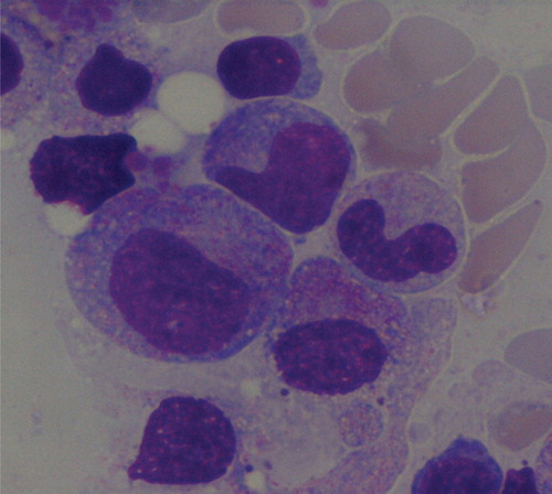 Figure 1. Type I agranulocytosis revealed prominent promyelocytes and metamyelocytes but rare mature forms (×1000).