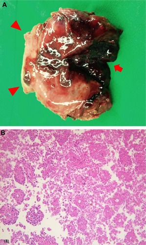 Figure 2 Surgical specimen and microphotograph.