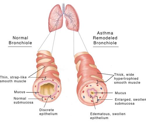 Figure 1 A cut away view of the structure of a normal and an asthmatic bronchiole, revealing the ASM cell hypertrophy with a thicker cross-sectional area and wider extension of the muscle across the outer surface of the asthmatic bronchiole. The muscle layer itself exhibits increased thickness. The airway lumen of the asthmatic bronchiole is decreased by the edematous swollen pseudo-columnar epithelium and submucosa, increased and edematous extracellular matrix, and the increased ASM thickness. The mucous secretions in the airway are also increased, contributing to the resistance to air flow. Current asthma therapies reduce the tissue swelling and edema, but not the increased thickness of the ASM and ECM.