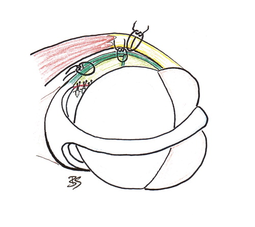 Figure 1. The Bankart repair with Figure 2. The modified Putti-suture anchors and capsular Platt procedure (Symenoides imbrication (Rockwood Jr Citation1990). 1991). Right shoulder seen from Right shoulder seen from above. above.