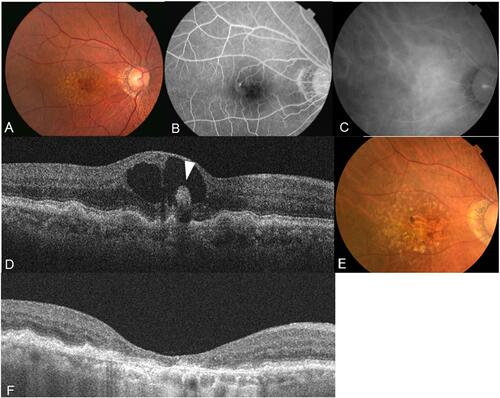 Figure 4 A 78-year-old man presented with decreased visual acuity in his right eye. (A) A color fundus photograph of the left eye showing multiple soft drusen and preretinal hemorrhage. (B) Early-phase fluorescein angiographic image of the fundus showing leakage from a retinal–retinal anastomosis and hypofluorescence consistent with hemorrhage. (C) Indocyanine green angiography showing no abnormal findings. (D) SD-OCT at baseline revealing intraretinal neovascularization without PED (white arrowhead). The visual acuity was 20/50 in the right eye, and the patient was diagnosed as having RAP stage 1. (E) In total, 36 ranibizumab injections were administered. Finally, at the 9-year follow-up examination, the patient’s visual acuity had decreased at 20/100. Macular atrophy developed. (F) SD-OCT showing the loss of RPE and outer retina.
