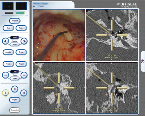 Figure 5. Measurement of the target positioning error by identification of the facial nerve with a tracked needle.