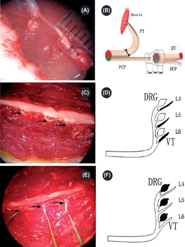 Figure 1. Operating microscope photographs (A, C, E, 10 × 5.5) displaying the gross anatomy of the surgical procedures and corresponding schematic drawings (B, D, F). PCP: proximal common peroneal nerve; PT: proximal tibial nerve; DCP: distal common peroneal nerve; DT: distal tibial nerve. A and B demonstrate the surgical procedure for generating the multiple regeneration animal model. The right common peroneal nerve was transected 10 mm distal to the sciatic nerve bifurcation point, and the proximal stump was separated. The PT was ligated at the bifurcate site and reversed. The broken end of the PT was sewn into the nearby muscle. A conduit was used to bridge the PCP with the DCP and DT. A 2 mm gap was left between the proximal and distal stumps. Pictures C, D, E, and F demonstrate the surgical procedure for purifying the peripheral nerve. The lumbar spinous process and lamina were removed to expose the cauda equina. C and D demonstrate the removal of the motor axons by ablating the right L4–6 ventral roots; E and F demonstrate the removal of the sensory axons by ablating the right L4–6 DRGs. The arrows in photo C indicate the right L4–6 ventral roots, and the arrows in photo E indicate the right L4–6 DRGs.