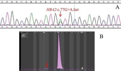 Figure 1. (A): The hemoglobin variant Hb Cibeles identified by Sanger sequencing. The arrow shows the mutation of the HBA2 gene (B): Hb Cibeles eluted in Z12 on the Capillarys 2 CE analyzer. The arrow shows the abnormal peak.