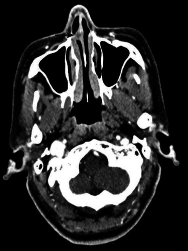 Figure 1 Enhanced CT showed flaky, thickened soft tissue lesions (black arrow) on the right side of the nasal septum.