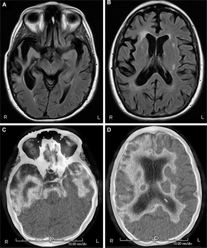 Figure 1 (A and B) MRI of brain, axial T2 Flair view, showing prominent bitemporal, right greater than left, atrophy. (C and D) PET imaging illustrating bitemporal and right frontal hypometabolism. There is extension of the hypometabolism to the right parietal lobe. All images are radiological convention with the left hemisphere on the right and the right hemisphere on the left.