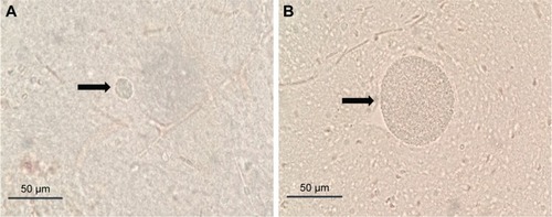 Figure 6 (A) Size of cysts in brains of mice treated with curcumin nanoemulsion; (B) size of cysts in brains of control mice without treatment.Notes: Arrow in (A) and (B) points at brain tissue cysts.