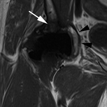 Figure 3. Severe adverse reaction to metal debris. Coronal T1W MR through the mid-coronal plane of the femoral head (black arrows indicate the medial wall of the acetabulum), demonstrating severe periprosthetic disease with bone marrow replacement in the acetabular roof (white arrow).