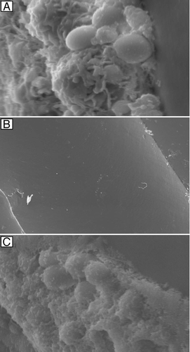 Figure 3 Effectiveness of antifungal lock therapy. Scanning electron micrographs of intraluminal catheter surfaces following 7 d of therapy with heparinized saline (magnification, 5,000x) (A), liposomal amphotericin B (magnification, 121x) (B) and fluconazole (magnification, 3,500x) (C) are shown. Adapted from Schinabeck et al.Citation8