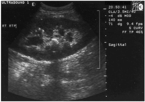 Figure 4. Ultrasound performed for acute deterioration in renal function showing hydronephrosis.