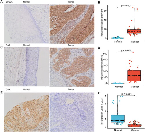 Figure 9. Immunohistochemical validation and RT-qPCR validation of key prognostic genes.Immunohistochemical results showed that SLC2A1 and CA2 were highly expressed in cervical cancer tissues, and CUX1 was lowly expressed in cervical cancer tissues (A, C, E), RT-qPCR results showed that SLC2A1 and CA2 were highly expressed in cervical cancer tissues, and CUX1 was lowly expressed in cervical cancer (B, D, F).