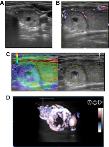 Figure 4 Low-risk nodules (A) with increased stiffness (B) and increased vascularization in volumetric evaluation (C) versus color Doppler (D) were reconsidered as intermediate risk lesions.