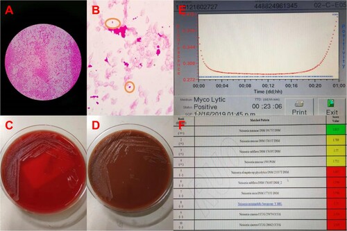 Figure 1. The blood culture was positive for N. macacae in 24 h. (A) Bacterial colony smear (Gram staining). (B) Blood culture was positive, then direct smear (Gram staining). (C) Blood plate for 72 h. (D) Chocolate plate for 72 h. (E) Time curve of blood bottle positive report. The blood culture was positive at 23 h 6 min. (F) The strain from blood culture was identified using MALDITOF MS.