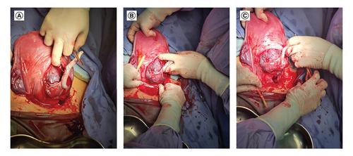 Figure 1. The technique of cervical ligation during cesarean section of patients with placenta accreta.(A) Cord clamping. (B) Cervical ligation by Foley's catheter. (C) Cessation of bleeding after cervical ligation.