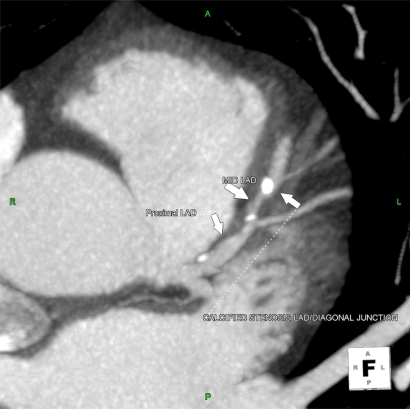 Figure 2 Illustration of soft and calcified plaque in proximal and mid LAD.