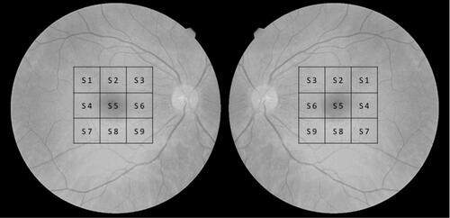 Figure 3 Nine-sectors-grid for vessel density measured by OCT-A for right and left eyes. Diagram showing the location of each studied sector in the OCT-A. The exam covers the 4.5×4.5 mm of the central macula. Note that in each area of the macula the grid is named equally to the same grid in the other eye in order to analyze them as the same topographic area. Also, correlation between OCT-A and microperimetry are calculated following this grid.Abbreviation: S, sector.