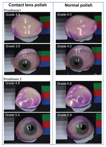 Figure 1 Deposit formation on the anterior and posterior surfaces of two prosthetic eyes.