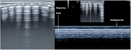 Figure 3. Normal lung LUS performance. On B-mode imaging, both the pleural line and A-line present as smooth, regular and hyperechoic lines, arranged in parallel and equidistant from each other, that is, a bamboo sign. On M-mode ultrasound, the presents as a sand beach sign.