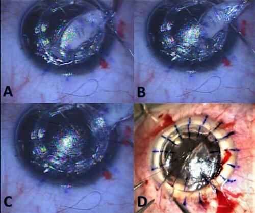 Figure 4 (A–C) The corneal graft is secured in place with a few interrupted sutures while pulling the stromal patch through the edge of the trephine. (D) another case. (Intraoperative picture) Pulling stromal patch out through the trephine edge (Intraoperative picture).