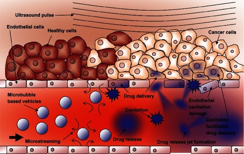 Figure 8 Schematic representation of ultrasound-triggered drug delivery on the cellular level.Notes: Microbubble-based drug-delivery vehicles flow through the vasculature into the ultrasound focal zone within the tumor region where they undergo cavitation. Microbubbles on the edge of the focal zone undergo some vibration, resulting in microstreaming. These two mechanisms help to increase the permeability of the cell membranes of the nearby endothelial cells, facilitating drug delivery to the tumor neovasculature. The inherent leakiness of the tumor vasculature allows some of the released drug to gain access to the tumor cells, which can be enhanced though damage done to the vasculature by the inertial cavitation shockwave. The concentration of the drug in the tumor circulation increases with further ultrasound pulses that allow fresh vehicles to enter the tumor. Over time, the drug has a chance to spread further into the tumor tissue. Drug that is not taken up by the tumor is swept downstream where it is diluted into systemic circulation, creating a dramatically smaller systemic dose than would be encountered by simply injecting the free drug into circulation.