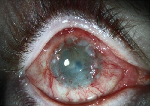 Figure 2 Limbal stem cell deficiency.