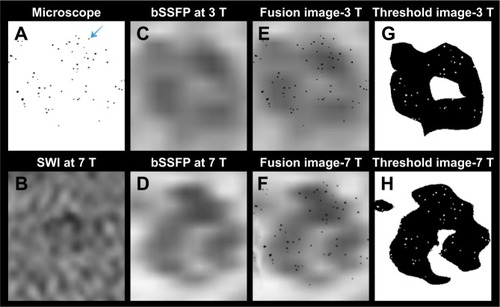 Figure 7 Diagram showing co-registration of microscope images and MRI of the phantom with 63 cells.Notes: Image registration was performed using b-spline transformation and mutual information metric provided in Elastix. (A) The microscope images of the 63 cells post-processed by ImageJ to show only the cells as dark spots. Blue arrow indicates the cells. (B) The SWI images of the 63 cells are too noisy for co-registration and overlay. (C) Zoomed 3 T RMS combined bSSFP image of the 63 cells. (D) Zoomed 7 T RMS combined bSSFP image of the 63 cells. (E) The fusion images of (A and C) after co-registration. (F) The fusion images of (A and D) after co-registration. (G) Image (E) post-processed with a threshold of 40% signal decrease. (H) Image (F) post-processed with a threshold of 40% signal decrease. More cells (51/63, 81%) are detected in 7 T images compared to 3 T images (36/63, 57%).Abbreviations: bSSFP, balanced steady-state free precession; MRI, magnetic resonance imaging; RMS, root mean square; SWI, susceptibility-weighted imaging.