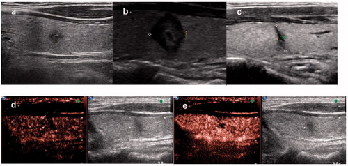 Figure 3. Microwave ablation (MWA) treatment and follow-up of one case of papillary thyroid microcarcinoma (PTMC). (a) Longitudinal ultrasound image demonstrating a 3 × 3×4 mm hypoechoic nodule with an irregular margin located in the left thyroid lobe before MWA. (b) One month after MWA, the ablation area was 10 × 10 × 9 mm and showed a well-defined margin. (c) Two years after MWA, the ablation area shrank to 2 × 8×1 mm with a well-defined margin. (d,e) CEUS showing a heterogeneous hypoechoic pattern.