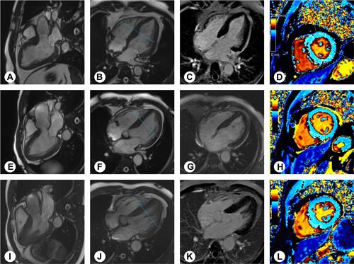 Figure 1 Images of a 47-year-old man with HHD (A–D). Images of a 59-year-old man with HCM (E–H), and follow-up after 3 year (I–L). Cine-magnetic resonance imaging in the three-chamber (A and E) and four-chamber (B and F) view showing similar looking hypertrophy of the interventricular septum in HHD and HCM, and the maximum septal wall thickness was 16 mm. And late gadolinium enhancement (C and G) was not found at the myocardium. At follow-up, theHCM myocardium became more hypertrophy, and clear lack of apical tapering. Native T1 maps in the LV center-chamber short-axis (D, H, L) showed with different average value: HHD=1195ms; HCM=1218ms; follow-up HCM=1285ms. Gray scale range: 0‒2000 ms. The blue line in (B, F, J) represented the level at which the short axis mapping image is positioned on the long axis image.
