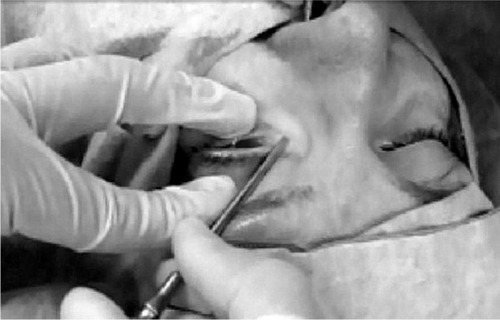 Figure 2 Trocar inserted through the lacrimal bone.
