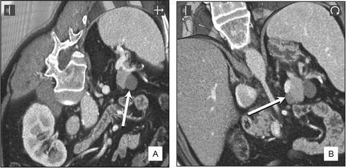 Figure 6. Two small cysts in the tail of the pancreas.