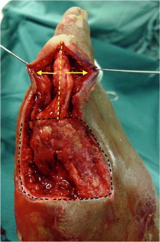 Fig. 2 Yellow dotted line showing the direct lateral incision made over lateral aspect of fourth toe, exposing the fourth toe phalanges and metatarsal head. Black dotted line showing the original surgical wound defect prior to reconstruction.