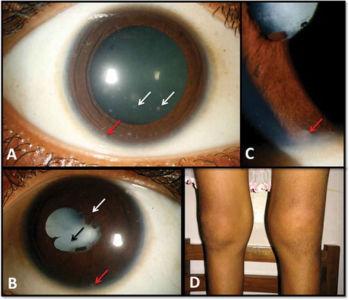 FIGURE 1. Clinical photographs. (A) Right eye: keratic precipitates (white arrows), iris nodules (red arrow). (B) Left eye: posterior synechiae (white arrow), complicated cataract (black arrow), iris nodule (red arrow). (C) Left eye: iris nodules (red arrow), magnified image. (D) Swelling of knee joints.