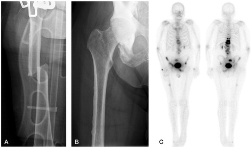 Figure 2. Patient 2. A. The right femur; atypical fracture. B. The right femur after the patient developed thigh pain, showing lateral cortical thickening of the diaphysis. C. Bone scan imaging obtained to evaluate the presence of metastatic disease, showing increased uptake in the right mid-diaphysis of the femur. This uptake was first thought to represent metastatic disease, although it ultimately proved to indicate stress changes within the bone prior to the completed atypical femur fracture.