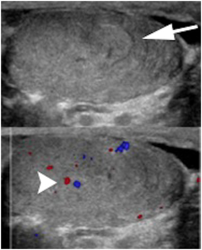 Figure 3 Seminoma: homogeneous large oval intratesticular mass lesion with internal hypervascularity.