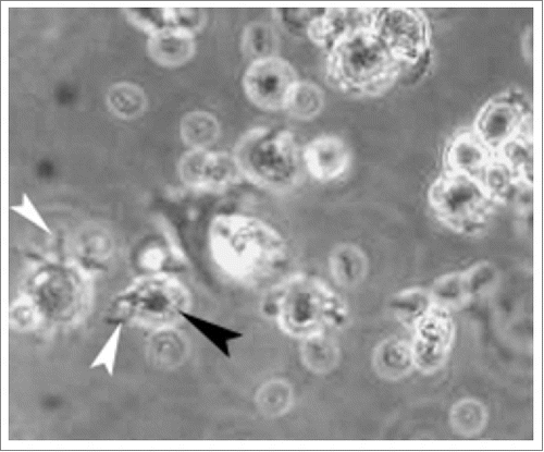 Figure 1. The morphology of mature DCs After stimulated with TNF-α, HPVm16E7-pulsed DCs in irregular shape showed mature characteristics of larger soma with plenty of dendritic long and small bulges on their surfaces (400 × magnification). White arrow indicates long bulge and black arrow indicates small bulge.