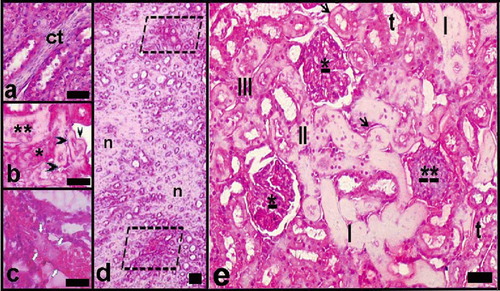 Figure 8. Light microscopy of kidney in the high-dose haloperidol-given group. Abbreviations: ct = enlarged connective tissue among the necrotic tubules. **Necrotic distal tubule. *Necrotic proximal tubule. Black arrow head = tubular basal membrane thickening and hyaline deposits; white arrows = venous thrombus and hyaline deposit-filled necrotic tubules. d indicates general view of renal medulla; n = necrotic areas, limited areas, blood vessels, and damaged tubules. e indicates a general view of the renal cortex. *Mesangial cell proliferation and focal necrosis in glomeruli; **Damaged glomerulus. t = tubules with hydropic degeneration; III, II, I = necrotic tubules at increasing degrees (the most in III). Arrows = tubular basal membrane thickening and hyaline deposits. Dye: Hematoxylin-eosin; Magnification bars: 50 μm.