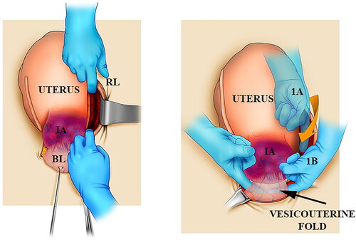 Figure 1. A scheme showing the basic steps for intrasurgical PAS staging. Left: After cutting the peritoneum medially to the round ligament (RL), fingers open the parametrial space between avascular fascia sheets. Right: From the upper position (A), the index goes down (B) by the subperitoneal tissue until crossing the fingers behind the bladder (BL) to perform a Pelosi maneuver. IA: invaded area.