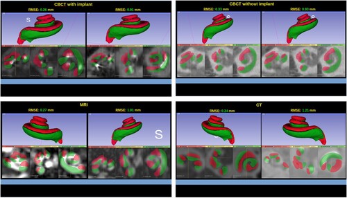 Figure 6 Sample of the results from different image types with RMSE values. In each group, the image on the left has the lowest RMSE value and the image on the right has the highest RMSE value. Each result has the 3D model at the top and the three standard views at the bottom, i.e. axial, sagittal, and coronal.