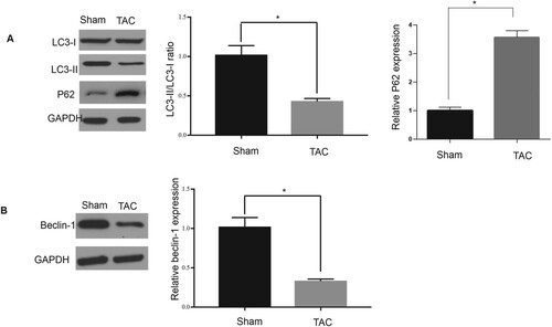 Figure 2. Decreased autophagy in hypertrophic cardiomyopathy. (A–E): Ratio of LC3-II to I, as well as levels of LC3-II and beclin-1, in heart samples; *P < 0.05.