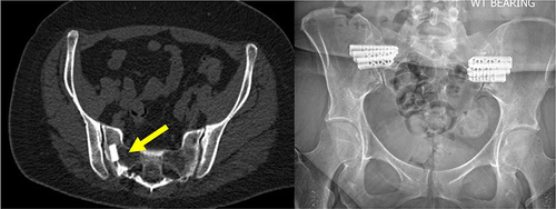 Figure 5 (Case 4). Yellow arrow shows SA implants in the sacrum, not in the joint space. Patient complained of continued pain on the treated side and new pain on the contralateral side. Patient underwent successful SI joint fusion using triangular titanium devices bilaterally.
