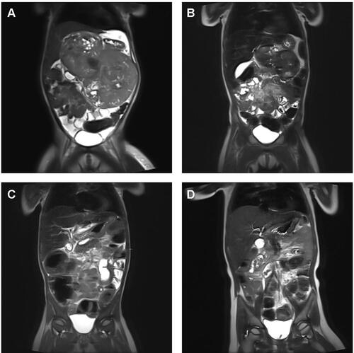 Figure 3 Response to standardized chemotherapy in a patient with extensive primary eMRT – Imaging results. (A) Diagnostic imaging at 27 months of age with inoperable, abdominal eMRT (14x14x9.8 cm), without distant metastasis, without germline mutation. (B) MRI before confirmed pathological diagnosis of eMRT, one course I2-VAd (ifosfamide, vincristine, Adriamycin) according CWS VAIA protocol, and after confirmed diagnosis, two courses ICE (ifosfamide, cyclophosphamide, etoposide) according EU-RHAB were given. After three courses of chemotherapy, tumor regression (5.6x8.8x4.2 cm), and stable disease < 25% was detected. (C) Imaging following chemotherapy according EU-RHAB was continued with one course of DOX (doxorubicin) and VCA (vincristine, cyclophosphamide, actinomycin D). Eventually the tumor was resected subtotally, and stable disease < 10% was achieved. (D) Following resection radiotherapy of the tumor bed (for abdomen up to 36 Gy) with boost to celiac trunk (up to 45 Gy) was performed, and therapy was completed with one course of VCA (vincristine, cyclophosphamide, actinomycin D), IC (ifosfamide, cyclophosphamide), VC (vincristine, cyclophosphamide) and DOX (doxorubicin) was given. The patient achieved complete remission, and is alive at 32 months following diagnosis.