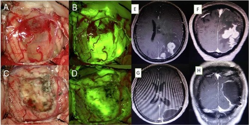 Figure 1 (A) Microsurgical photograph of the right parietal lobe under white light and (B) the yellow 560 filter from initial stages of tumor resection. (C, D) Residual tissue located in the deep area of the resection cavity was identified under fluorescence compared to white light. (E–H) Axial and sagittal magnetic resonance imaging showing complete removal of the tumor.