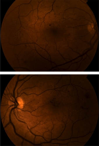 Figure 1 A) Color fundus photograph of the right eye. B) Color fundus photograph of the left eye.