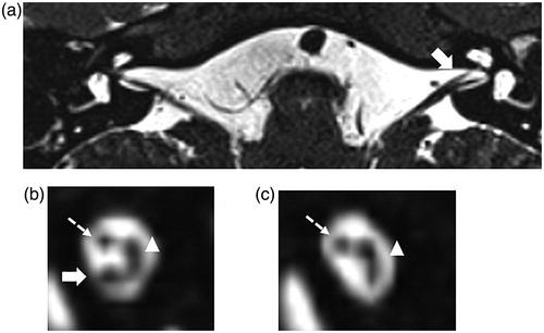 Figure 1. MRI images of the IAC in a CND case (Case No. 32). This case (Case No. 32) had right ear deafness and was diagnosed with CND. (a) shows an axial image of the IAC. The cochlear nerve in the IAC in the affected ear (left ear) could not be detected, while it can be detected in the IAC of the unaffected ear (right ear, solid arrow). (b) shows a sagittal section of the unaffected IAC in which the cochlear nerve (solid arrow), vestibular nerve (arrowed head), and facial nerve (dotted arrow) can all be detected. (c) shows the IAC on the affected side. The vestibular nerve (arrowed head) and facial nerve (solid arrow) can be detected and a defect in the cochlear nerve is shown.