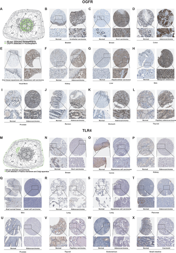 Figure 4 Representative immunohistochemistry images showing the levels of protein expressions by (A–L) OGFR and (M–X) TLR4 in normal and tumor tissues in pan-cancers from the HPA database.
