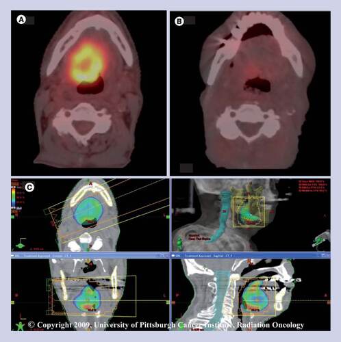 Figure 1. Representative recurrence of head and neck cancer with pre- and post-stereotactic body radiation therapy positron-emission tomography-computed tomography. (A) Pretreatment positron-emission tomography-computed tomography (PET-CT) demonstrates base of tongue recurrence. (B) Post-treatment PET-CT demonstrates complete response to stereotactic body radiation therapy (SBRT) at 8 weeks. (C) SBRT plan prescribing 8.0 Gy/fraction to 80% isodose line.© 2009, University of Pittsburgh Cancer Institute, Radiation Oncology.